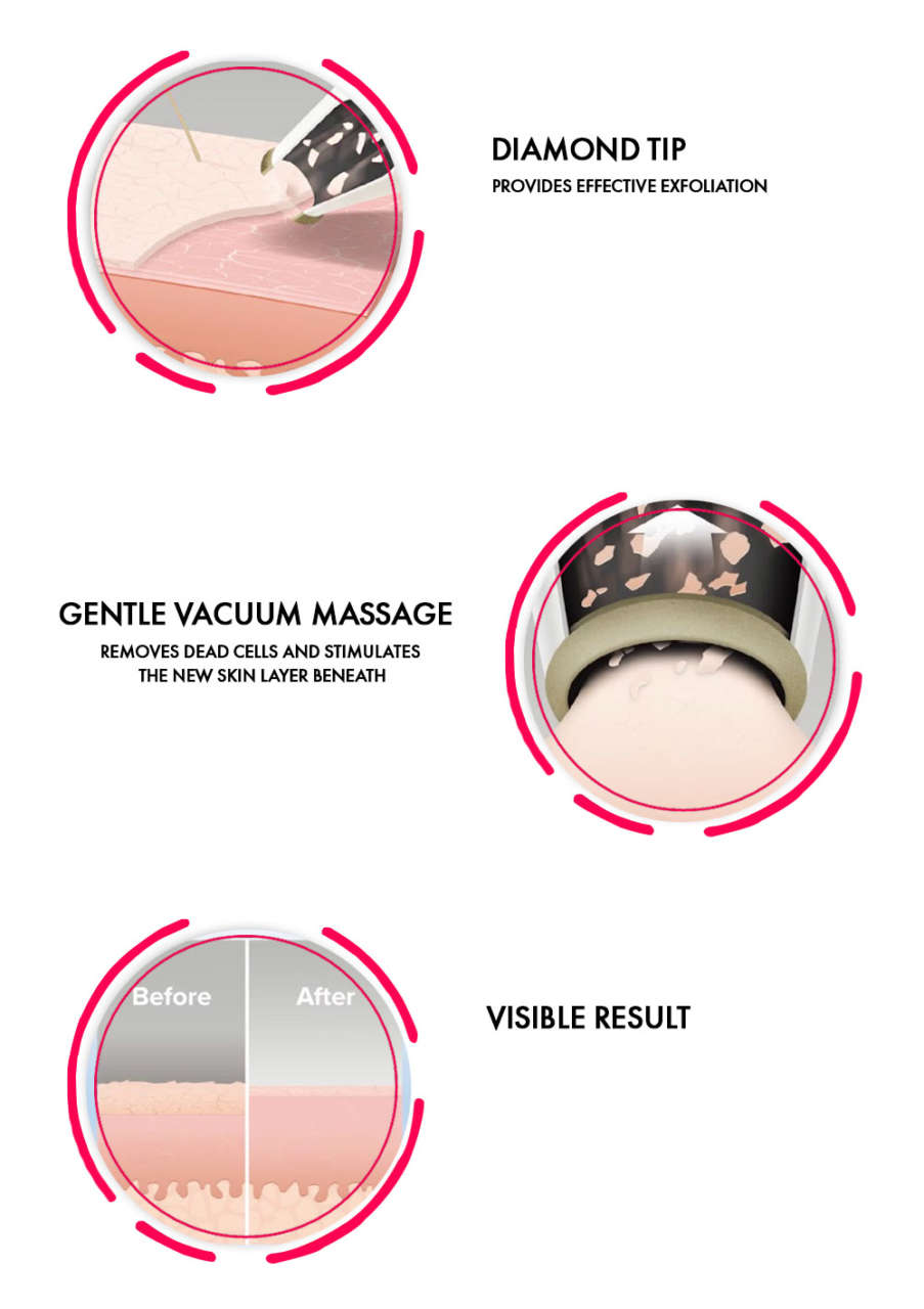 Everything You Need to Know About Microdermabrasion